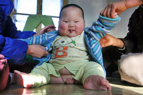 Obese Asian Baby 100